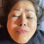 Microdermabrasion