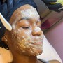 Teen Acne Facial