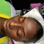 Microdermabrasion