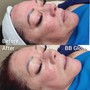 Acne Facial