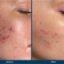 Microdermabrasion