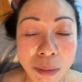 Microdermabrasion with Facial