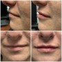 Nasolabial Folds and Marionette Lines