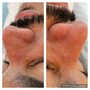 Microdermabrasion