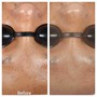 Acne Facial