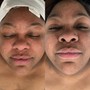 Acne Facial