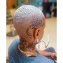 Alopecia Hair loss