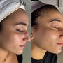 Acne Facial