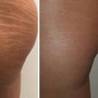 RF Tightening and Cellulite Treatment w/ Butt Lift