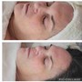 Facial