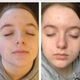 Microdermabrasion