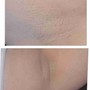 Microdermabrasion