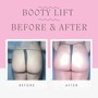 Non invasive bbl/ butt lift