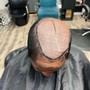 Scalp Treatment