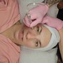 Diamond Dermabrasion Facial