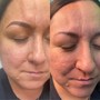 Eyebrow: Microblading