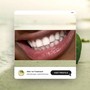 Teeth Whitening