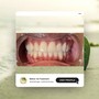 Teeth Whitening