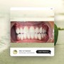 Teeth Whitening