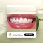 Teeth Whitening Follow Up