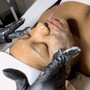 Microdermabrasion Facial