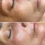 MicroNeedling