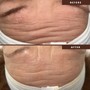 Facial tightening