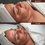 Facial tightening