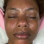 Body Microdermabrasion