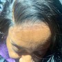 Scalp Treatment