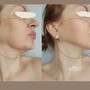 Oxygen Facial