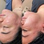 Black Head Removal