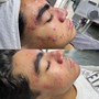 Dermaplane Facial