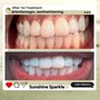 Teeth Whitening Follow Up