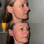 Face Lift (one session)