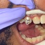 Tooth Gem Removal