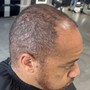 VERSAL Hair Line Restoration