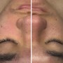 Microdermabrasion Facial