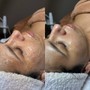 Dermaplane Facial