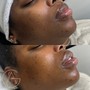 Acne Facial