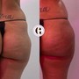 Cellulite Treatment