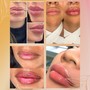 No Needle Lip Filler (1ml)