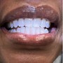 Advance teeth whitening