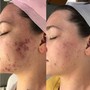 Face Reality Acne Consult