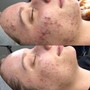 Face Reality Acne Consult