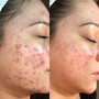 Chemical Peel