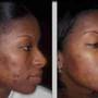 MicroNeedling