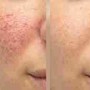 MicroNeedling