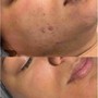 MicroNeedling