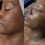 Dermaplaning